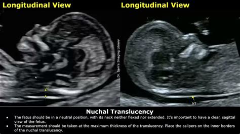 nuchal thickness should not be measured after 20.6 weeks|nuchal translucency measurement.